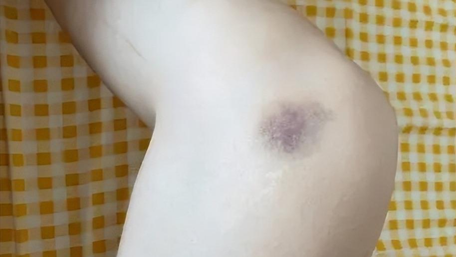 冷知识！为什么女生的身上莫名出现淤青？