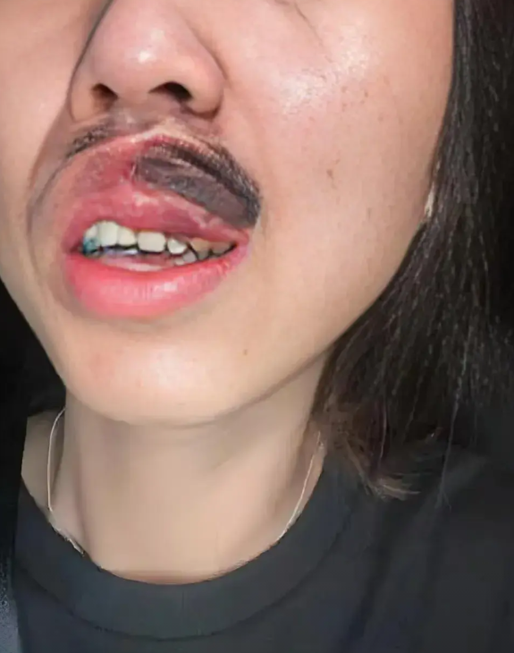 太可怕了？
  在湖南女大学生在宿舍睡觉，睡梦中感觉嘴巴刺痛，惊醒后发现自己的嘴