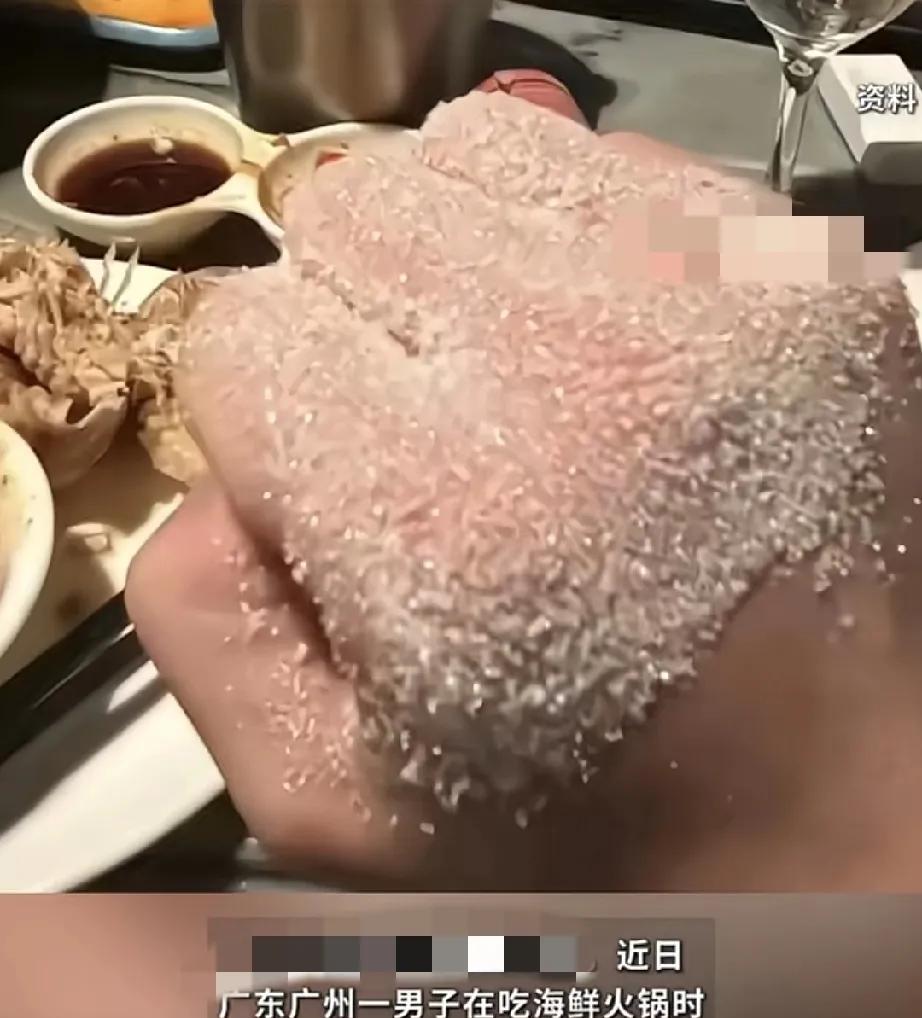 广东一小伙，在吃海鲜火锅时，不慎被火锅底料烫到了右手背，小伙赶紧冰敷，但还是疼痛