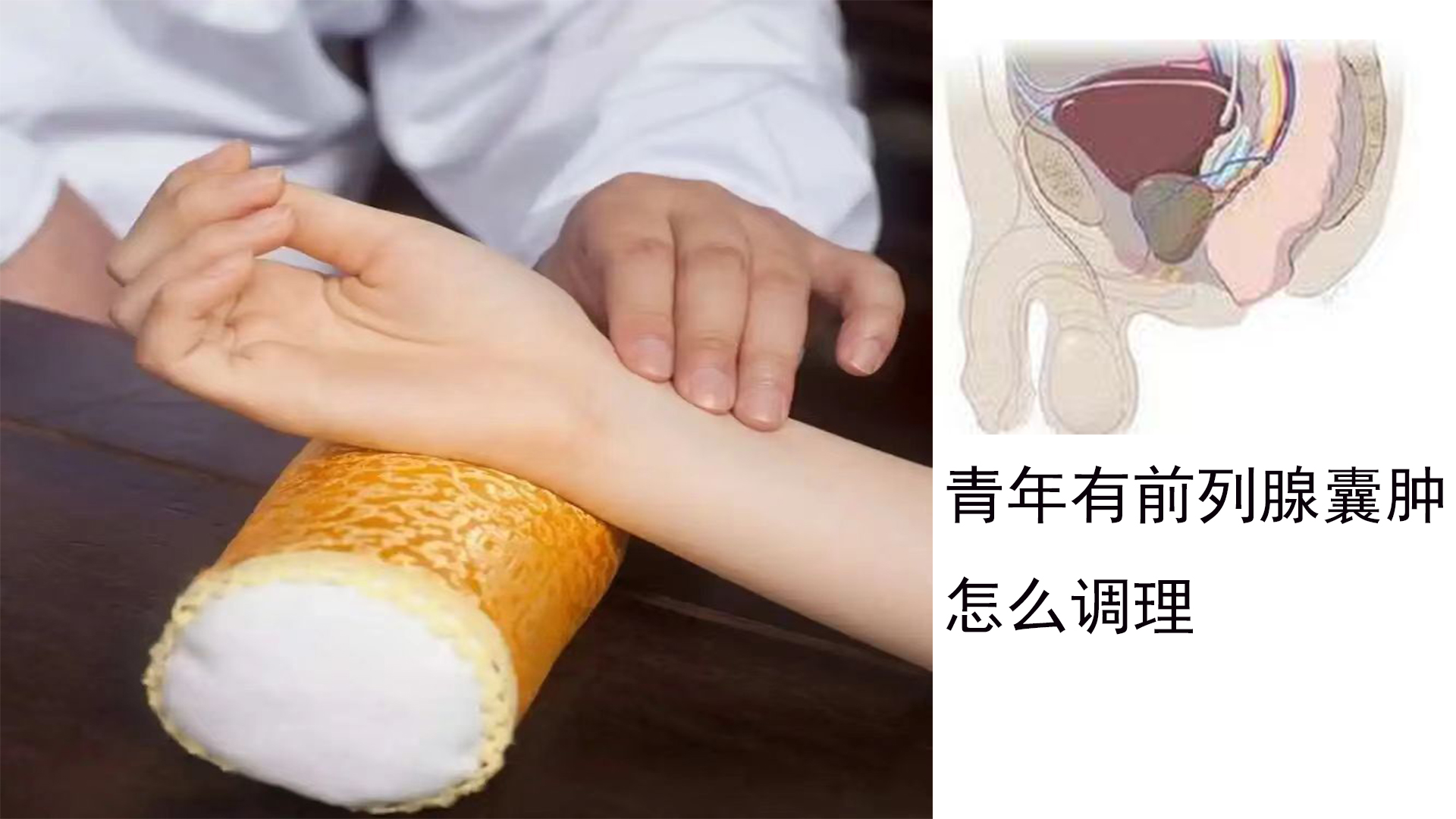 青年男性发现前列腺囊肿怎么办