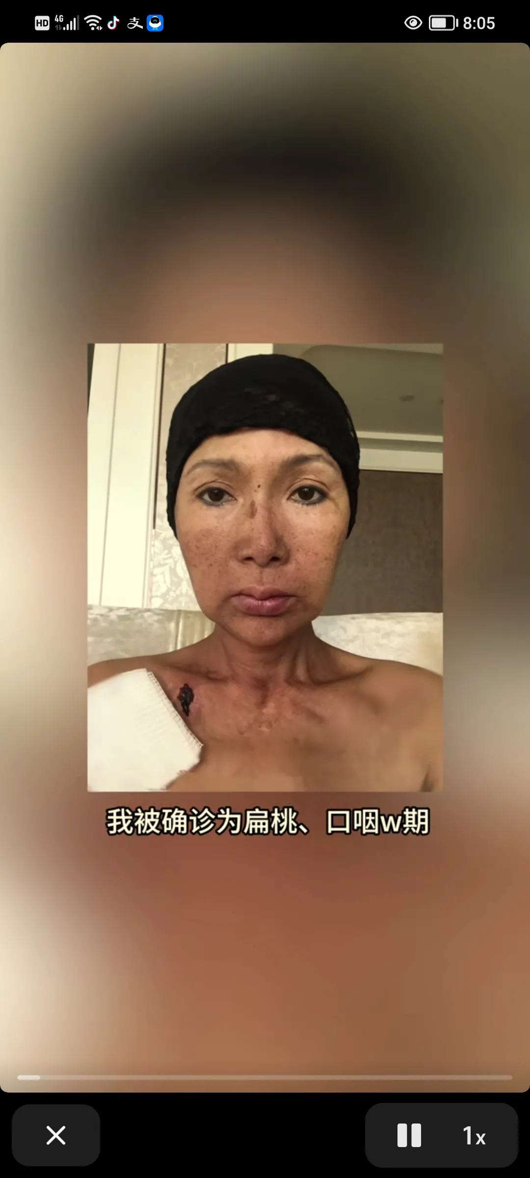 哇塞！张咪真的太厉害了。
她居然在经历了5年、25次的放疗之后，成功战胜了癌症。