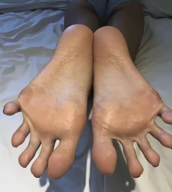 第一次和男友约会，被嫌弃脚丑，能治吗？