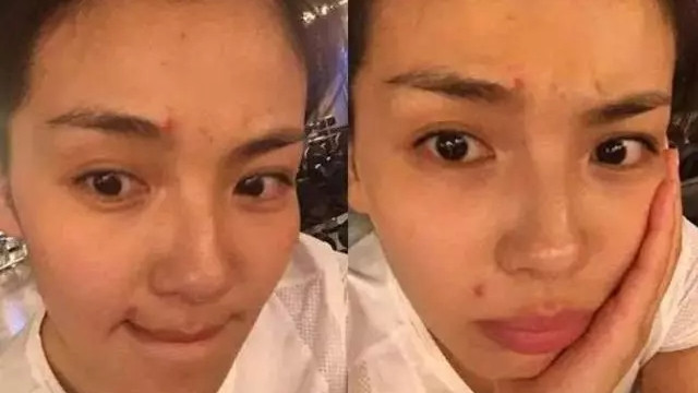 关于黑头、粉刺、闭口、痘痘，女生最爱问的16个问题，一口气全部回答完