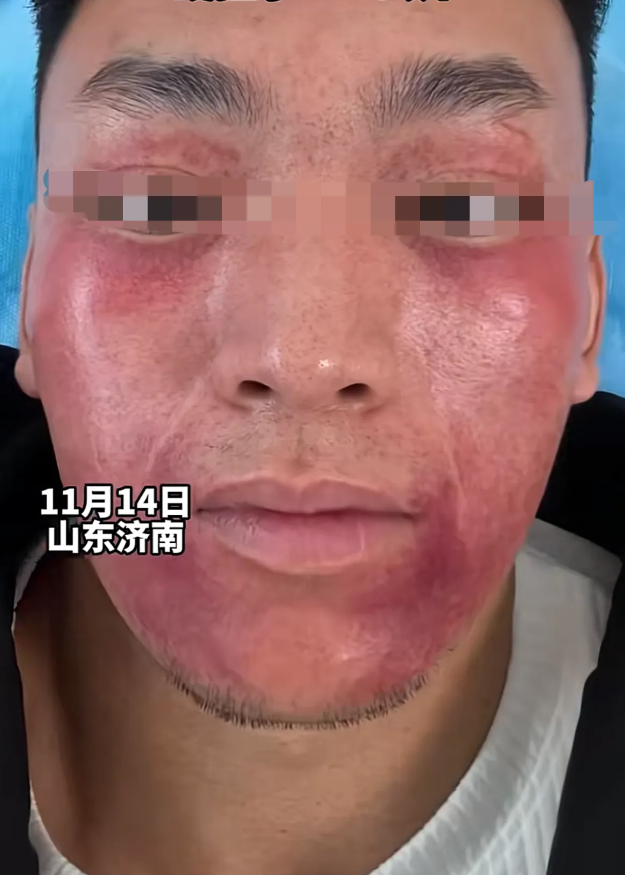 山东济南，一男子健身之后变成了“关公”，网友调侃：这下知道为什么关公脸红了。
