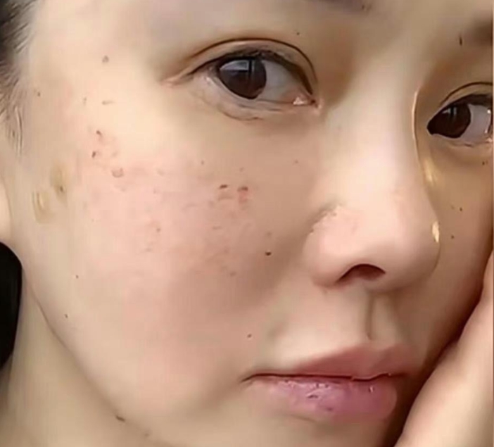 伊能静大方晒出自己的打针照片，果然，女明星为了容颜不老都很拼