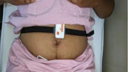 IMU评估产后腹直肌分离康复训练