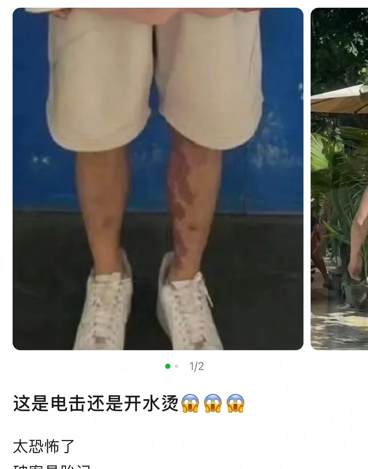 破案了，星星腿上的红斑不是被打了或者什么伤痕，而是胎记！