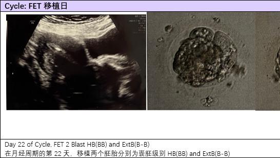 真实自述：卵巢功能低下怎么办？迎来新生命稳妥上岸！