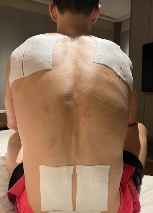 这是孙杨睡觉前，和全国游泳锦标赛接受检录时的照片，身上密密麻麻的膏药星罗棋布，如