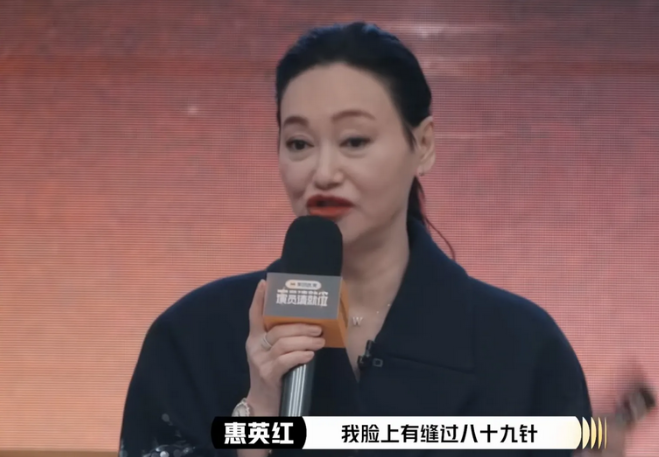 惠英红说:我是整过容的。

我脸上有缝过八十九针，你看我的嘴唇是打开的。

因为