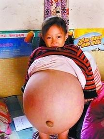 四岁女孩肚子大 房东一句话救命

                       