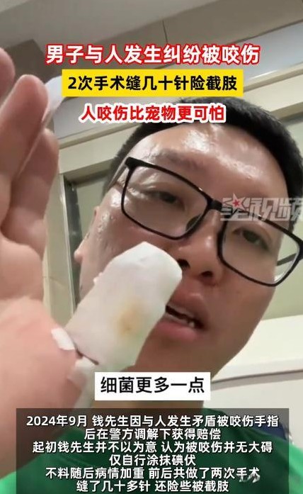 “这是属狗的吧？”在一个寻常的日子里，江苏一男子因与人发生冲突，不慎被对方咬破手