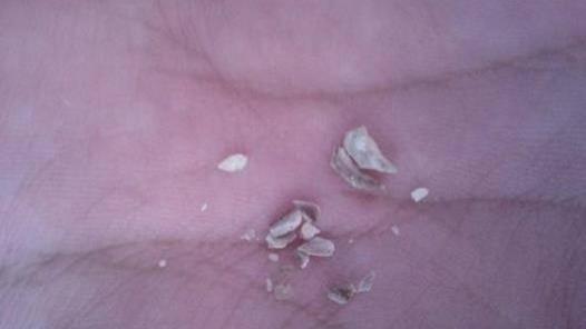 牙齿上长出“小石头”，味道又臭又硬，闻一下差点吐了