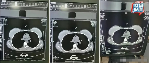 无锡虹桥医院摊上大事，医院竟然赶在检查组来之前，把相关影像数据毁了，系统也改了，