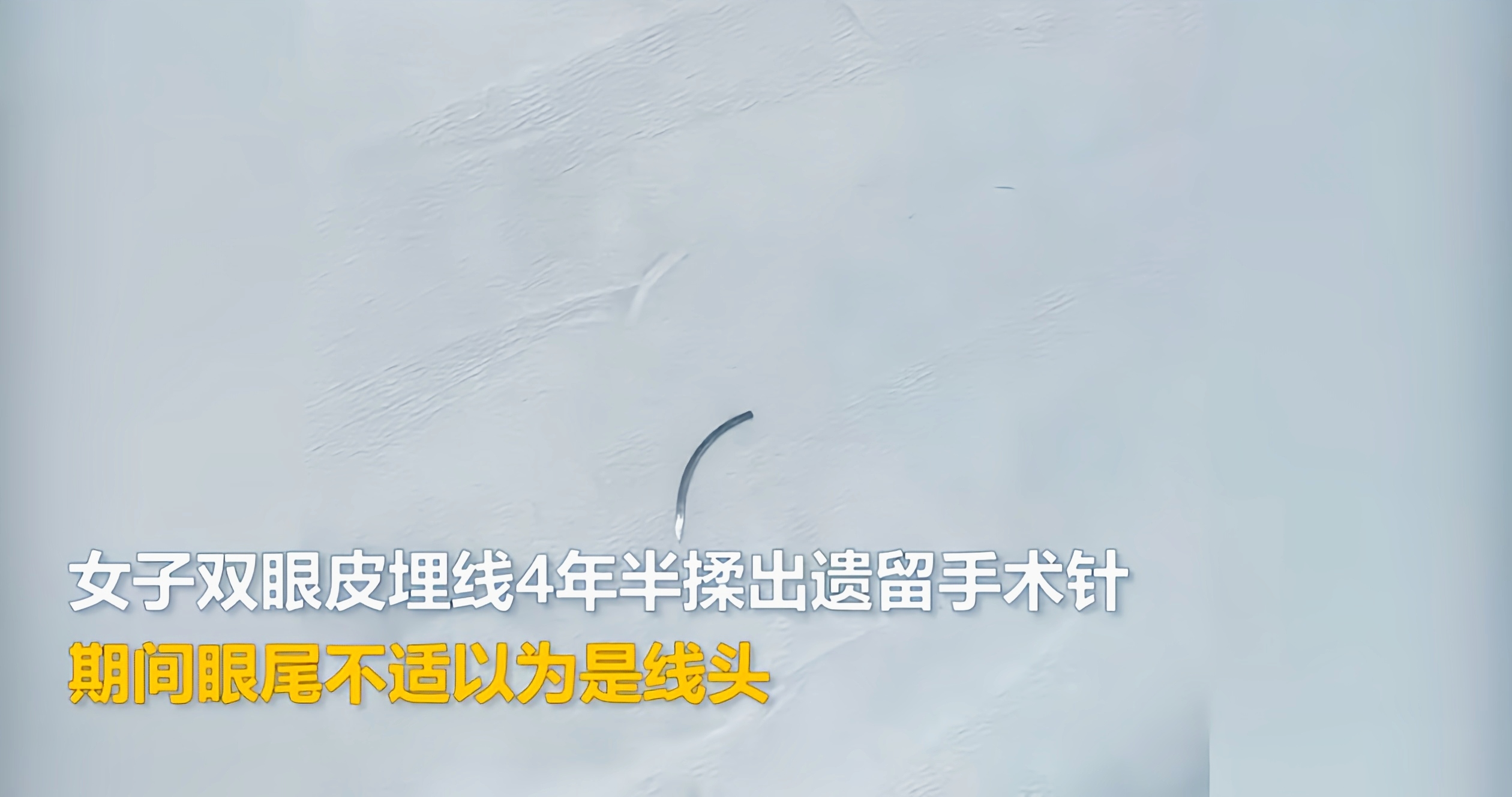 眼皮惊现弯针！医美事故谁担责