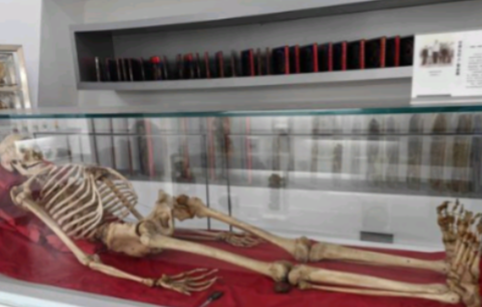 2005年，湖南湘雅医学院的标本室里，放着中国“第一女巨人”曾金莲的遗体，白布包