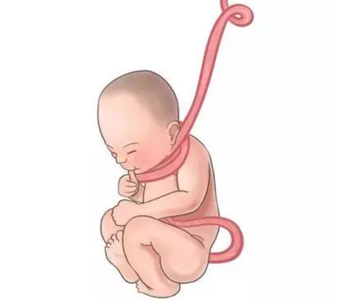 宝宝脐带绕颈一周有危险么？