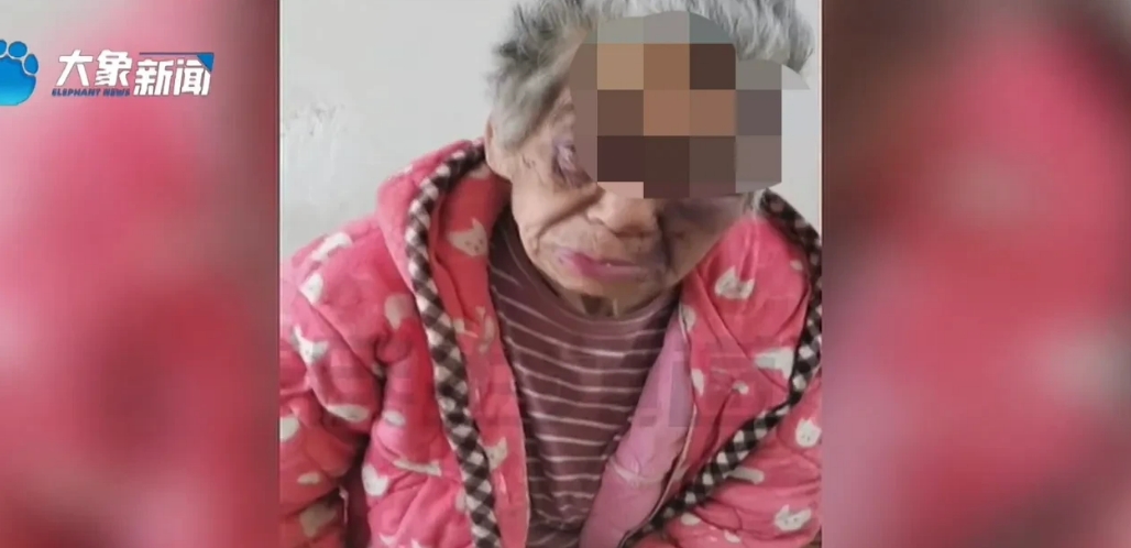 河南漯河，7旬老阿婆居住在养老院期间，家属发现其肋骨断了七根、头上有一条长达20