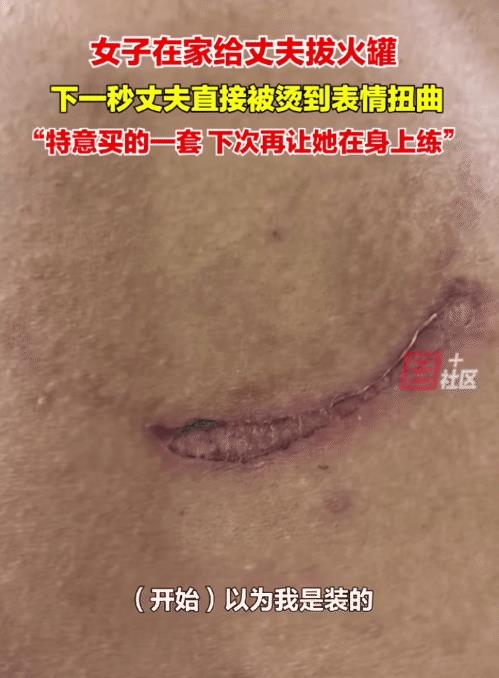 “老婆，你拔罐不专业。”近日，河北邯郸。一男子洗完澡回来，老婆说: “给你拔个罐