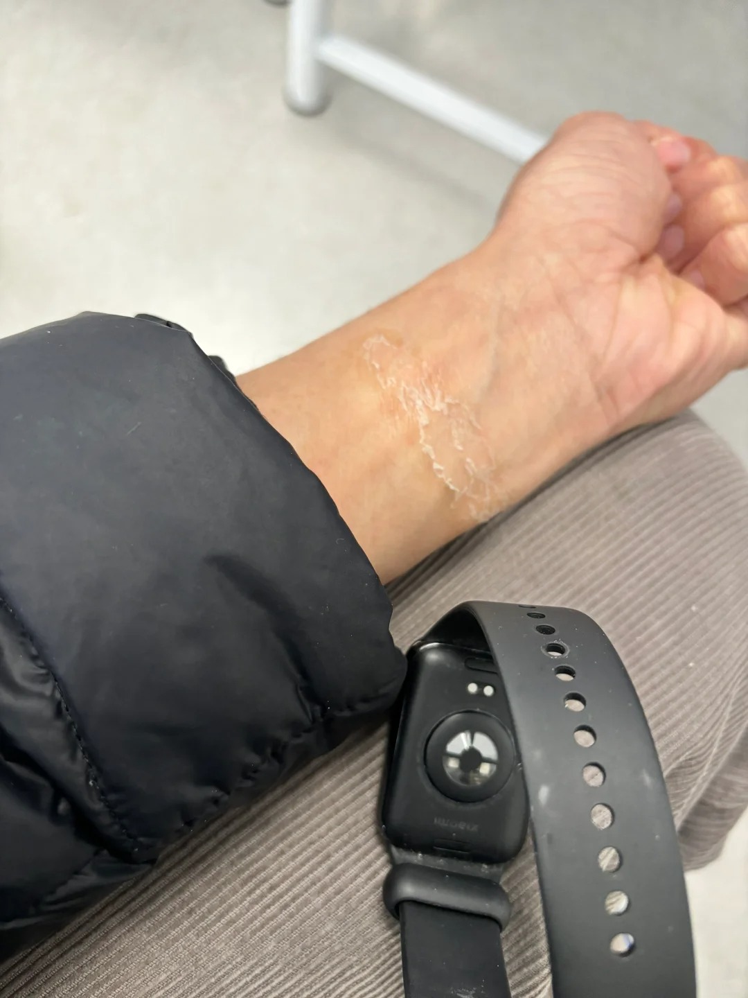小米8pro手环是不是毒，戴了一周脱皮好严重
之前拿下充电，就发现这块发红，过了