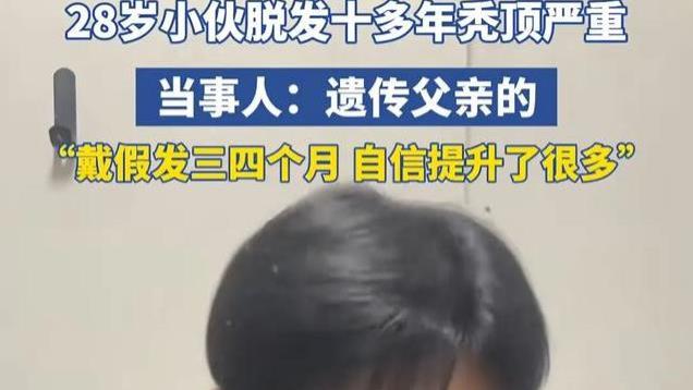 28岁小伙遗传秃顶，戴上假发秒变帅哥，网友：相亲时先薅一把头发