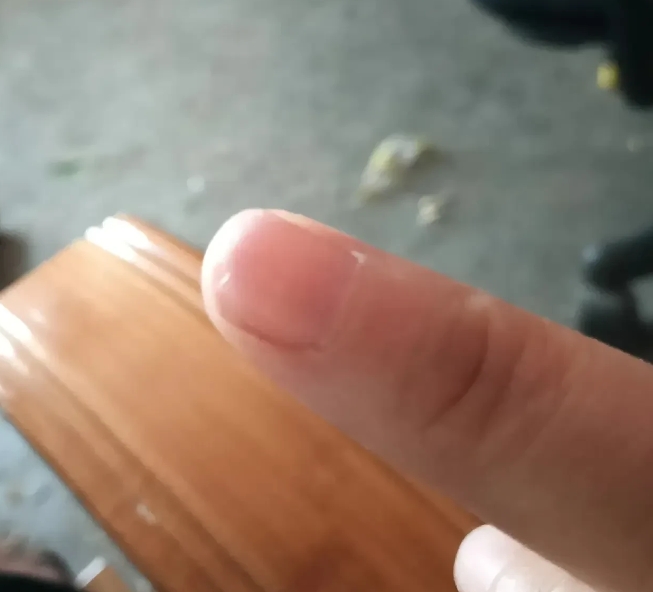 家人们我太崩溃了！这几天做饭切菜，刀下去的时候太突然，直接把指甲给削掉了一块。当