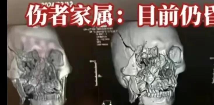 河南一男子过年燃放烟花把自己炸到面目全非，头骨碎裂惨不忍睹，至今昏迷不醒。该男子