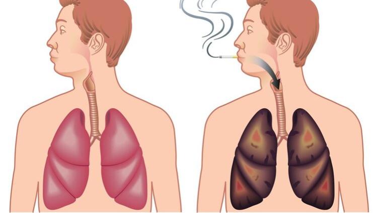 戒烟后变黑的肺能白回来吗？患癌几率能下降吗？医生告诉你真相