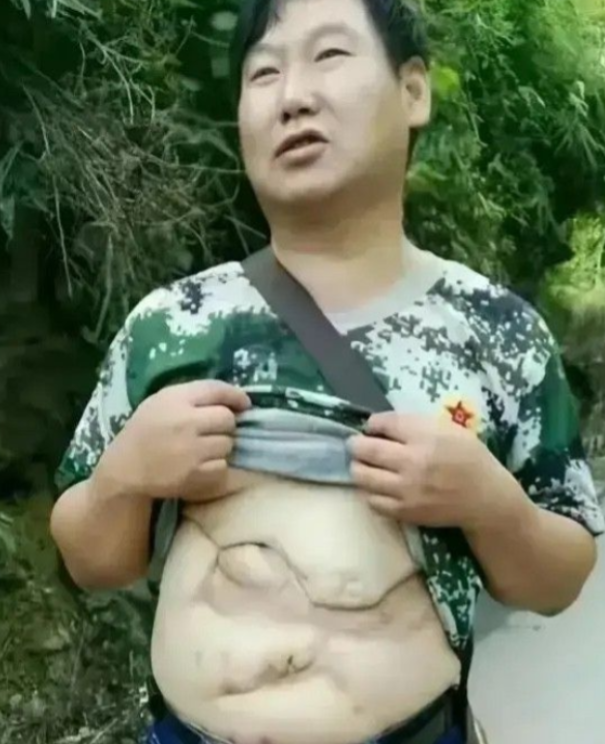 一等功臣雷毅，腹部被敌人炮弹炸开，11个器官被击穿，取出32块弹片，他掀起衣服那