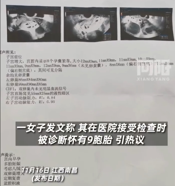 怀9胞胎女子丈夫再发声，近日，江西南昌。一女子在医院接受检查时被诊断怀有9胞胎引