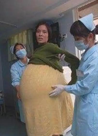 [太阳]2009年，广东一女子怀胎12个月后仍未生产，到医院检查后医生竟吓出一身