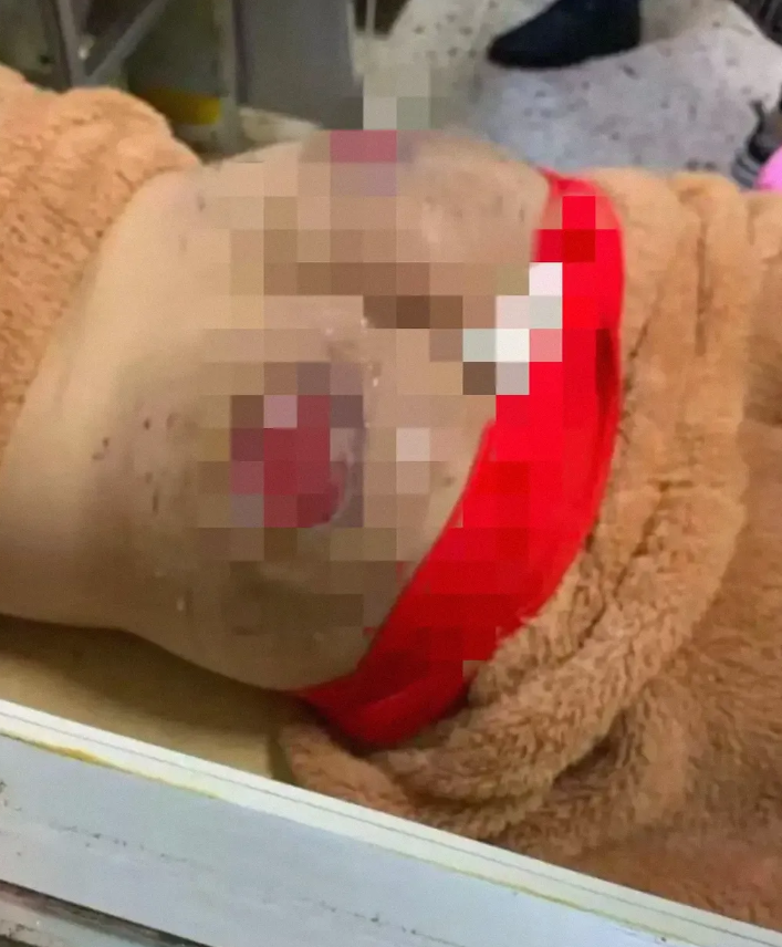 缅北电诈的“猪仔”陈锦和，在失联 4 个月后终于获救，但其状况令人痛心。他的屁股