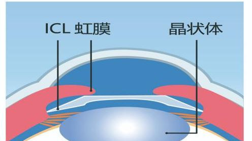安全、稳定、可逆 ，一文读懂ICL晶体植入手术