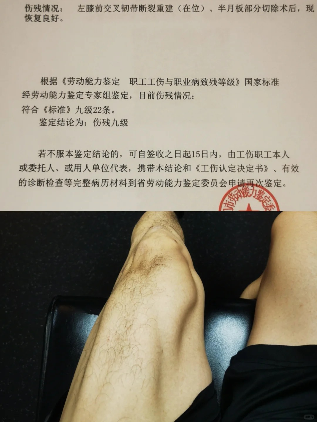 喜提九级伤残
咱也是官方认定的伤残人士了
这里必须给厦门人社工伤保险处的办事效率