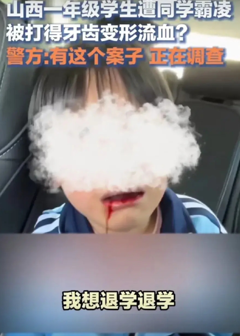 10月15日，山西晋中一年级学生遭同学霸凌被打得牙齿流血变形。该小女学生表示想退