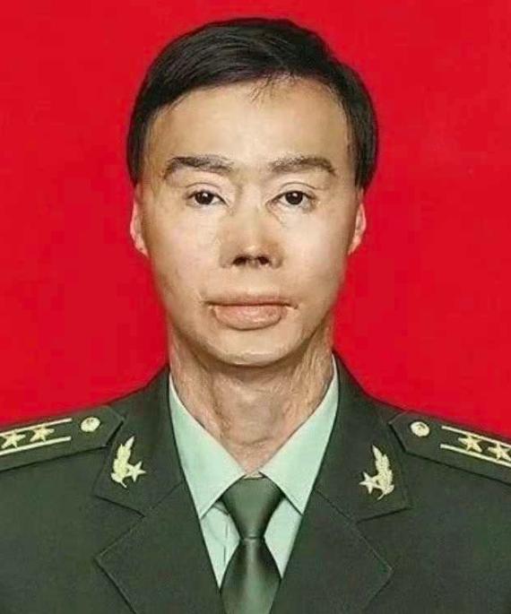 梁强英勇救出27名乘客，却身受重伤，全身85%烧伤。历经6000余块植皮、40多