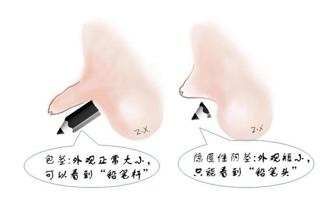 12岁男孩“丁丁”短小仅1厘米性格内向，医生：隐匿性阴茎是小男孩常见病，约每30