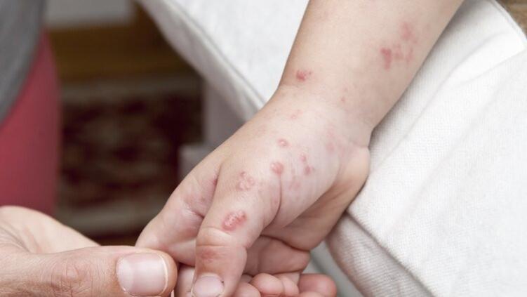 一旦感染终身携带！发作时痛不欲生，超9成人体内潜伏有这种病毒