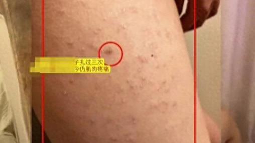 章丘女学生遭霸凌，腿部被扎200多下，事件引发社会广泛关注