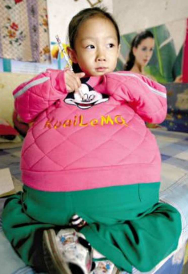 山西 4 岁半的胡云星，肚子鼓胀大如临盆孕妇。医生断言，孩子活不过三个月，家人陷
