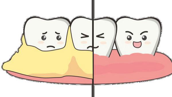 口腔出现这5种情况，说明你该洗牙了