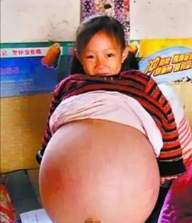 女孩肚子变大 多方求医终治好

                        