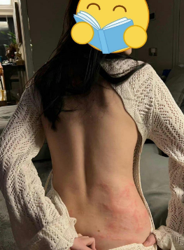 有没有皮肤科的，这是怎么了？​​​