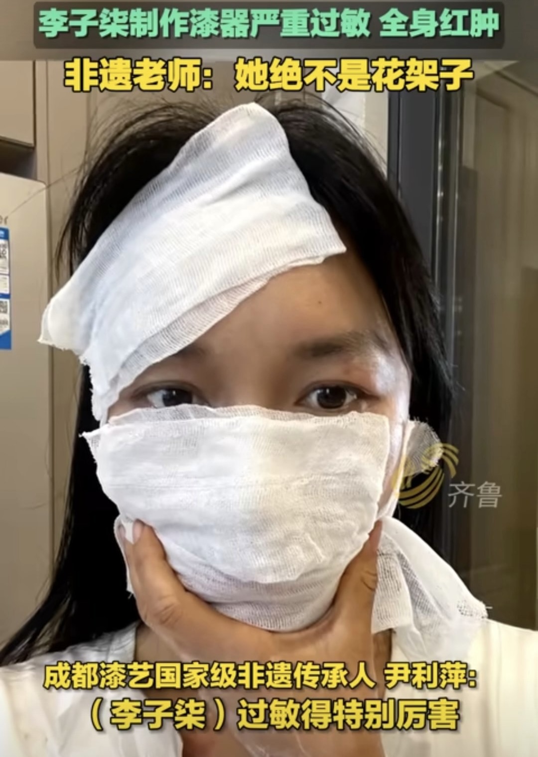 李子柒过敏满脸纱布全身红疹