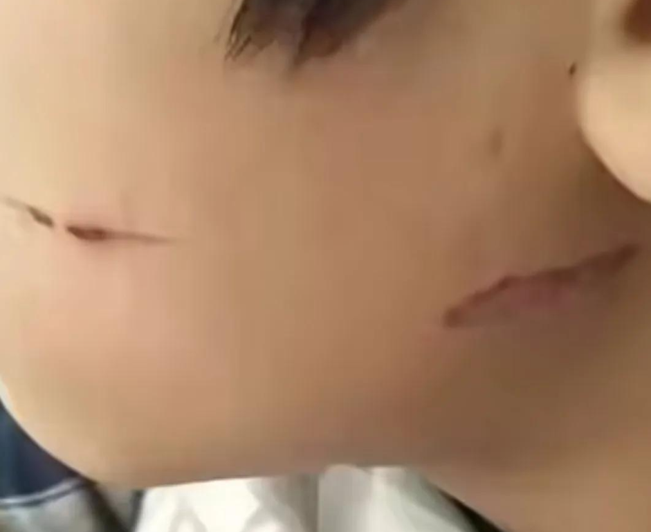 就这？14岁男生被5名同学打耳光烫脸，校方：一巴掌赔100