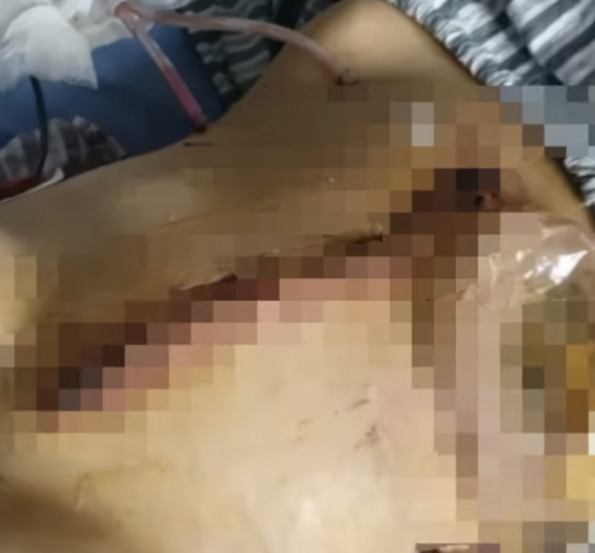 《成都女子被家暴致终身残疾》
事实再次证明家暴只有零和无数次的分别。发生了家暴除