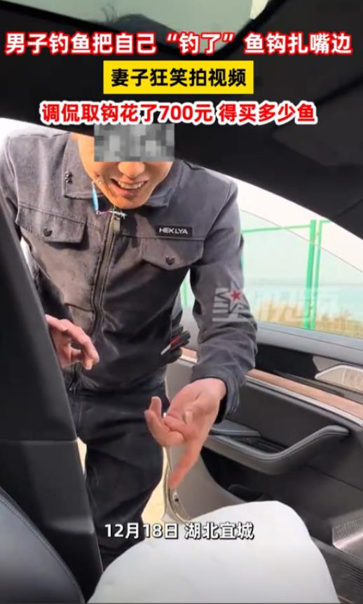 湖北宜城，男子来湖边钓鱼不慎将鱼钩扎入了嘴边，本来是来钓鱼的，没想到鱼一脱钩直接