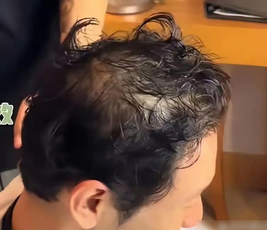 黄晓明剪头暴露真实发量，也快变成地中海了...