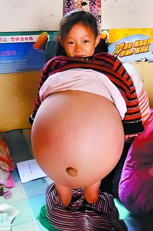 2010年，山西4岁女孩胡云星，肚子超大鼓胀得像孕妇。医生预言活不过三个月，就在