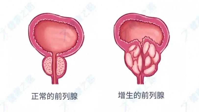 中老年人的前列腺增生是怎么出现的？